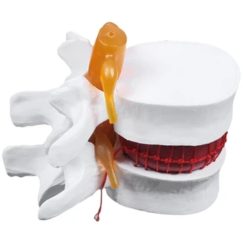 1 Kos Okostje Ledvene Hrbtenice Disk Herniation Poučevanja Model & 1 Kos Človeške Anatomije Okostje Vretenc Hrbtenice Model