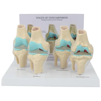Koleno določenega Modela Človeškega Telesa Anatomija 4-Stopenjski Osteoartritisa Kolena Skupno za Zdravnike Urad Izobraževalno Orodje