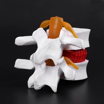 Človekove Anatomski Ledvenega Diska Herniation Model Medicinske Naučijo Pomoči, Anatomijo Instrume Dropship